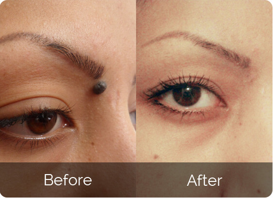Michael's skin tag removal results