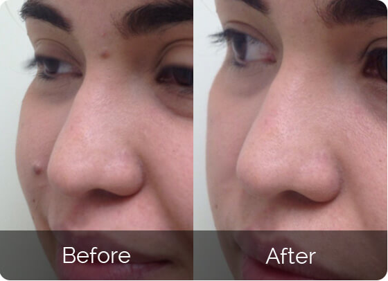 Robert's skin tag removal results