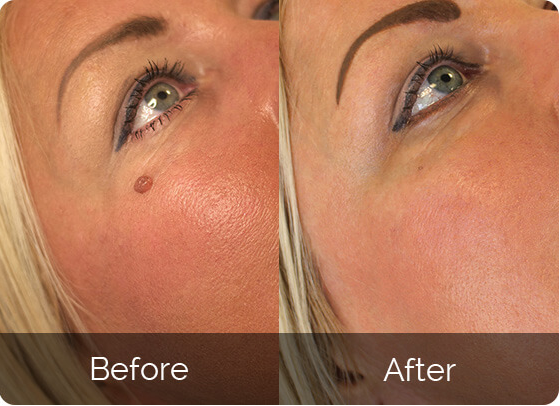 Amanda's skin tag removal results